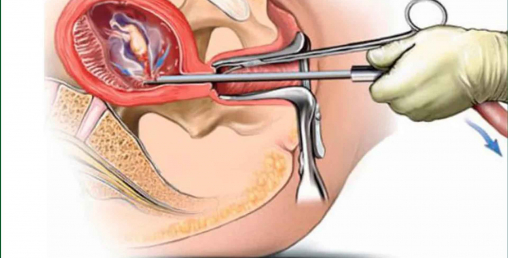 अमेरिकामा गर्भपतन गर्न नपाइने, देशव्यापी विरोध सुरु