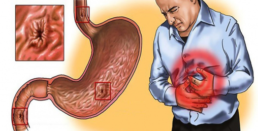 ग्यास्ट्रिकका बिरामीले दशैंमा के खाने, के नखाने ?
