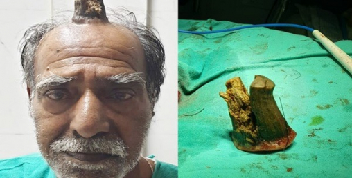 मानिसको टाउकोमा सिंङ पलाएपछि…