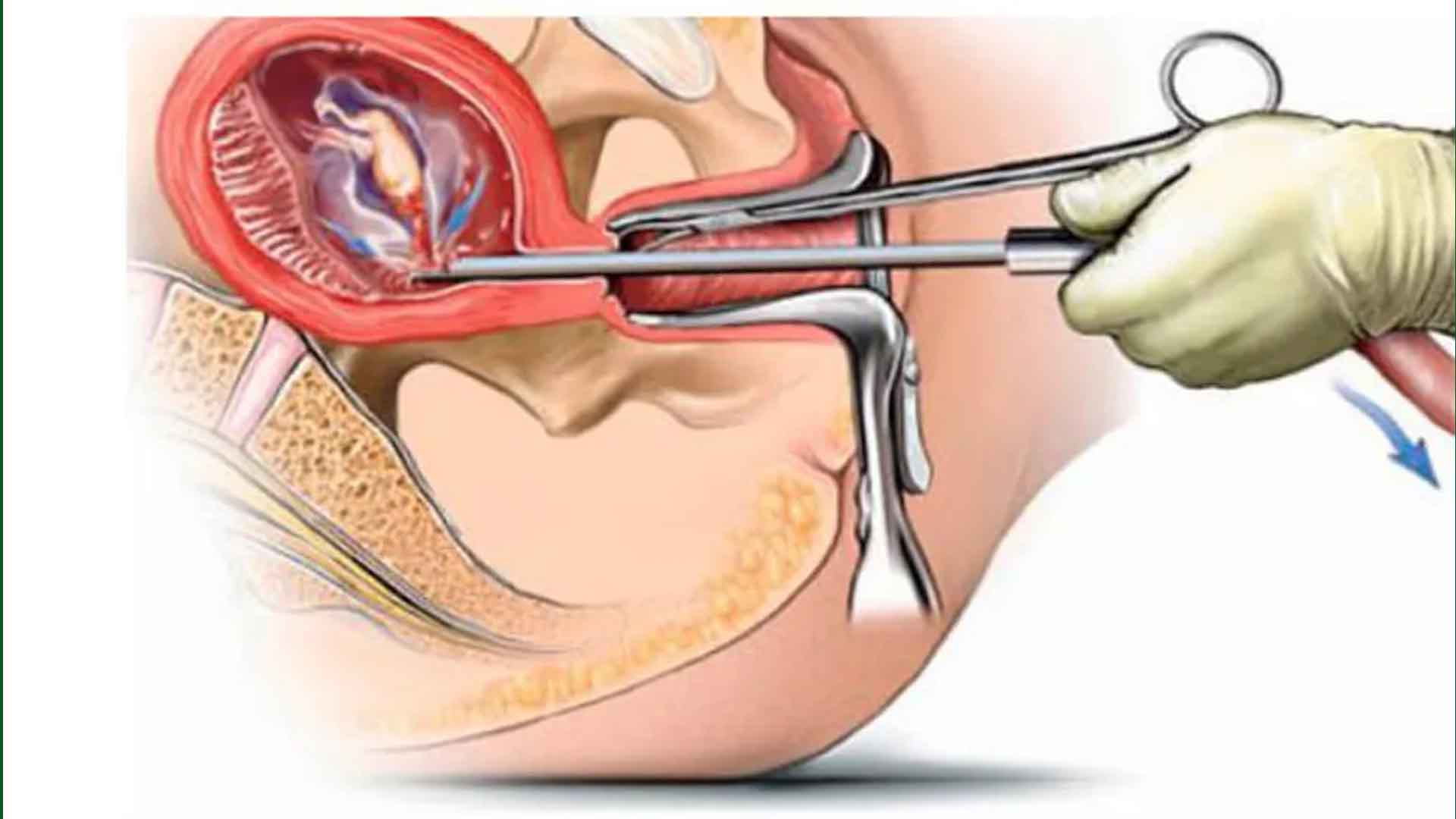 अमेरिकामा गर्भपतन गर्न नपाइने, देशव्यापी विरोध सुरु