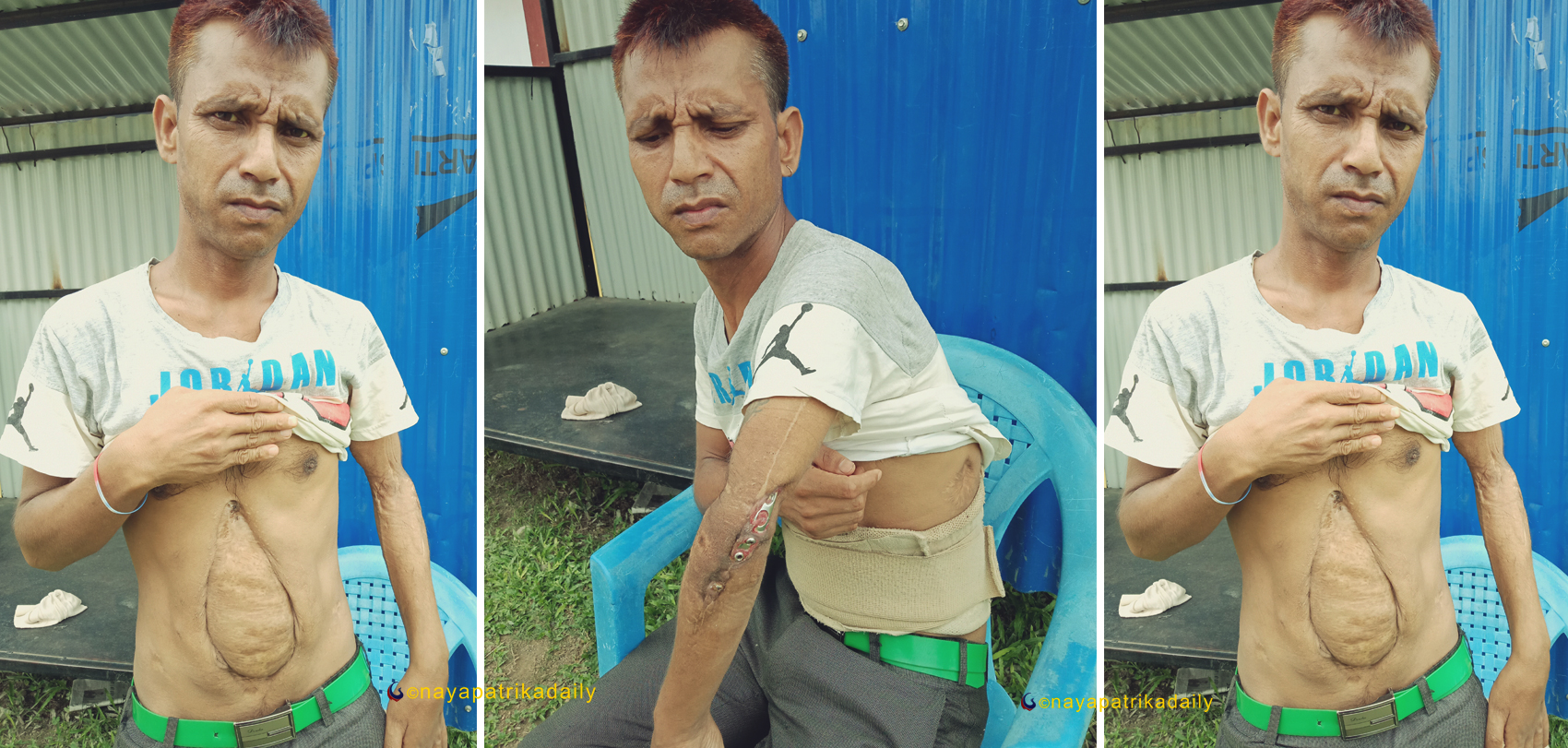 मेयरलाई ३० लाख क्षतिपूर्ति, उही घटनाका घाइतेले उपचार खर्च पनि पाएनन्