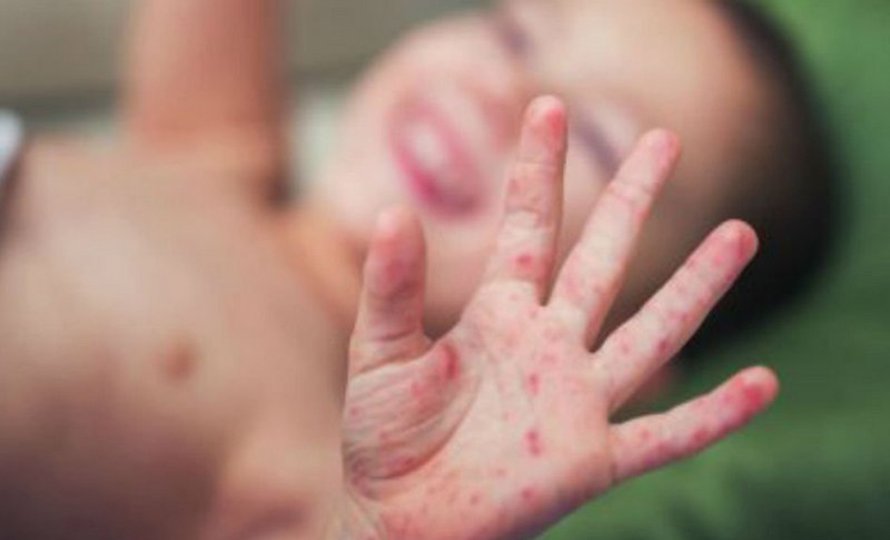 सन् २०२६ सम्ममा दादुरा निवारणका लागि खोप ल्याउन गाभीलाई पत्र