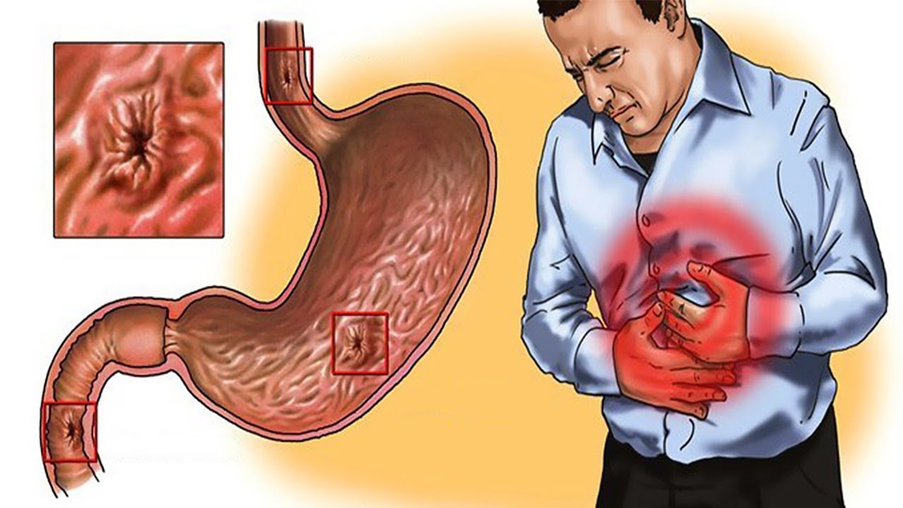ग्यास्ट्रिकका बिरामीले दशैंमा के खाने, के नखाने ?